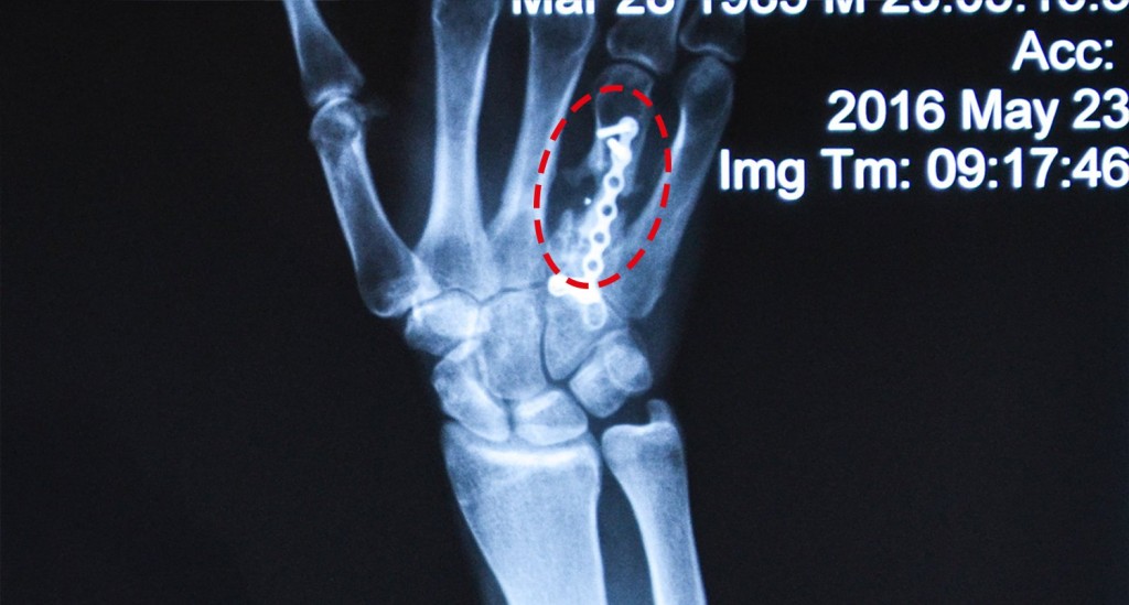 Hand-X-ray-Sergiy-Mih