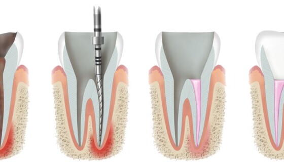 Скільки каналів у зубах: діагностика та лікування патологій ендодонту в клініці Lumident
